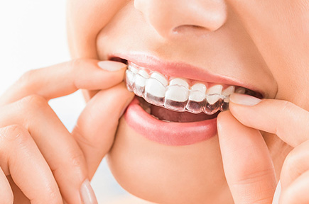 Orthodontie mineur (Invisalign)